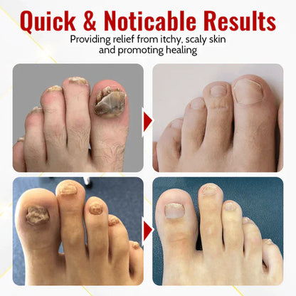 Japanese NailViva Onychomycosis Rapid Relief Oil